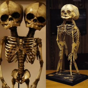 Discovering the Unusual: Exploring the Fascinating Conjoined Twin Skeleton at the Mütter Museum!